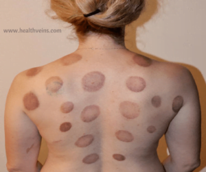 benefits of cupping