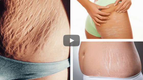 how to get rid of stretch marks fast and naturally