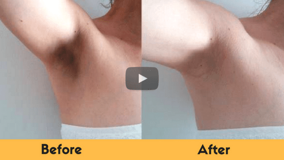 how to get rid of dark underarms naturally