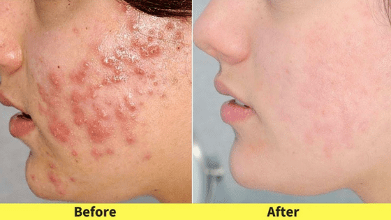 lighten acne scars naturally