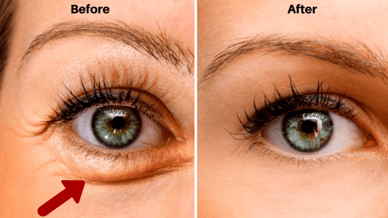 how to get rid of bags under your eyes