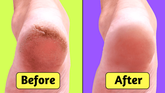 how to heal dry cracked feet naturally
