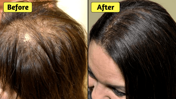 How To Stop Thinning Hair Naturally