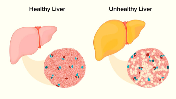 how to get rid of fatty liver disease naturally